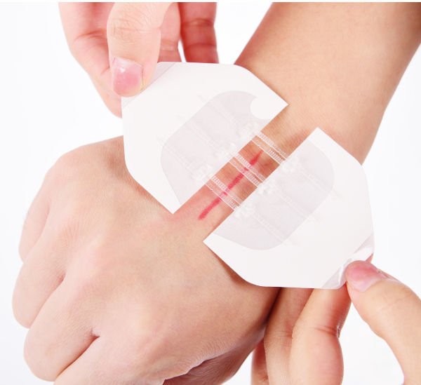 Wound Closure Device